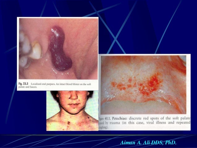 prozac bleeding disorders