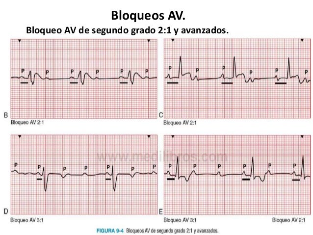 Bloqueos aurículoventriculares