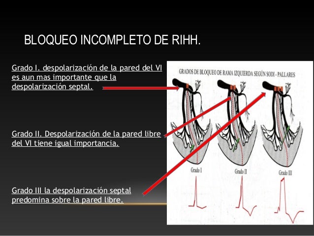 Bloqueos de rama del Haz de His