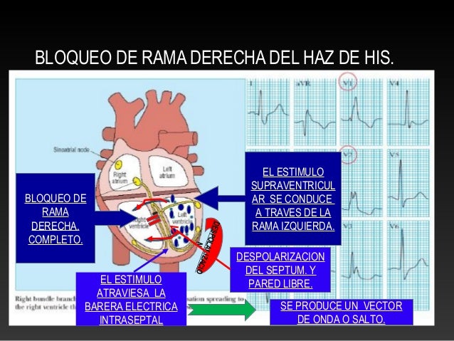 Bloqueo Incompleto De Rama Derecha Del Haz De His