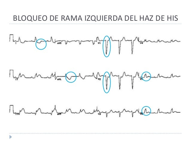 Bloqueos de rama del haz de his
