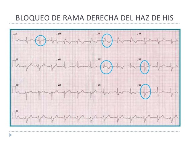 Bloqueos de rama del haz de his