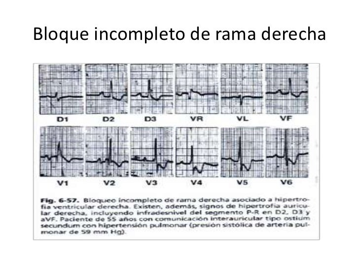 Bloqueos de rama y bloqueos fasciculares