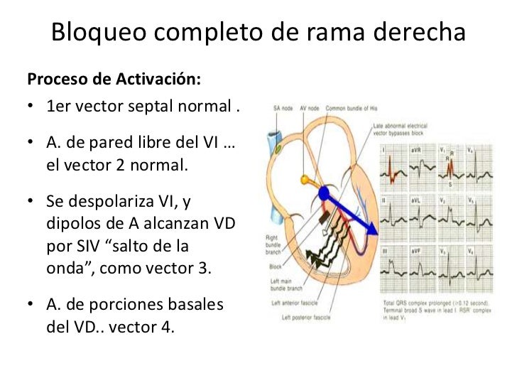 Bloqueos de rama y bloqueos fasciculares
