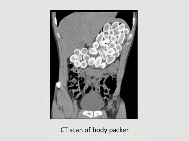 Image result for body packer