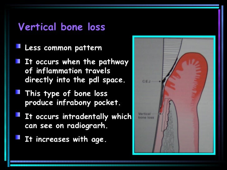 Bone loss
