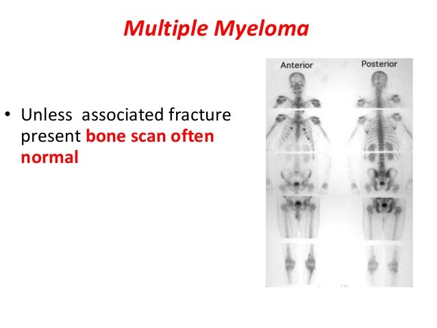 multiple myeloma ct bone