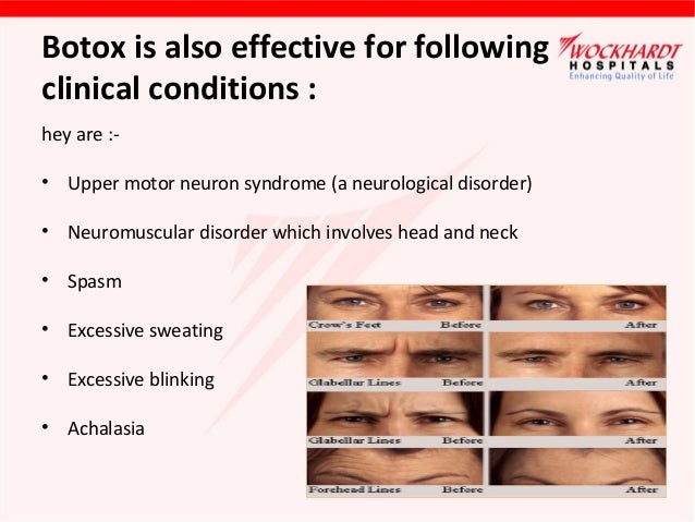 Cosmetic Injection Facts And Myths Cosmetic Injection Facts And Myths
