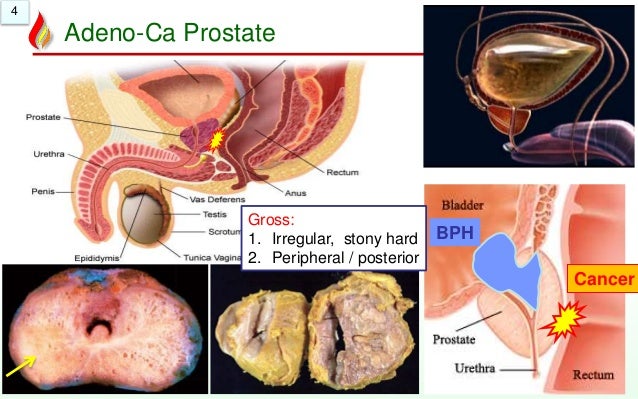 Prevention of breast most cancers desire at last liver most cancers degree four how long to stay
