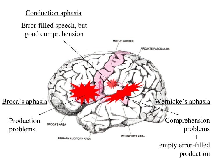 Brain And Aphasia