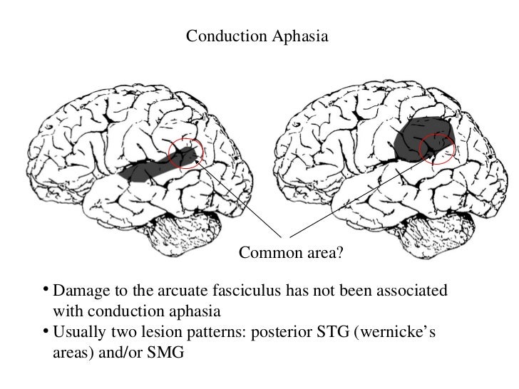 Brain And Aphasia