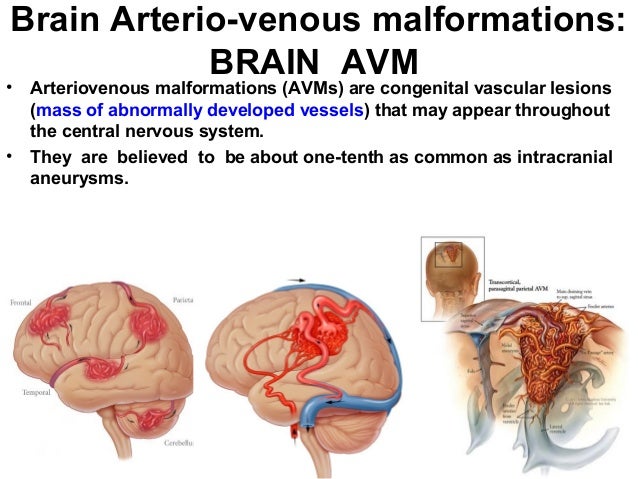 cerebral arteriovenous malformation essay Arteriovenous malformation (avm) intracranial aneurysm – localized dilation of a cerebral artery, most commonly berry shaped – usually arising from an. cerebral arteriovenous malformation essay Arteriovenous malformation (avm) intracranial aneurysm – localized dilation of a cerebral artery, most commonly berry shaped – usually arising from an.