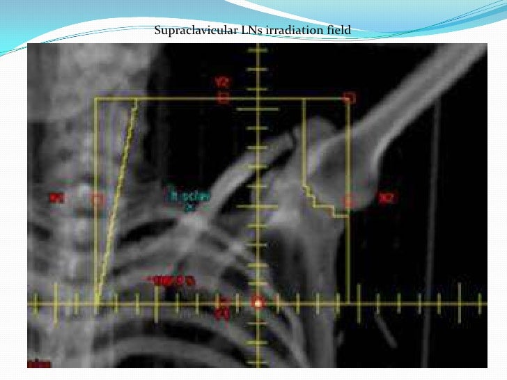 physiotherapy treatment for cervical cancer how is degree four cervical most cancers handled