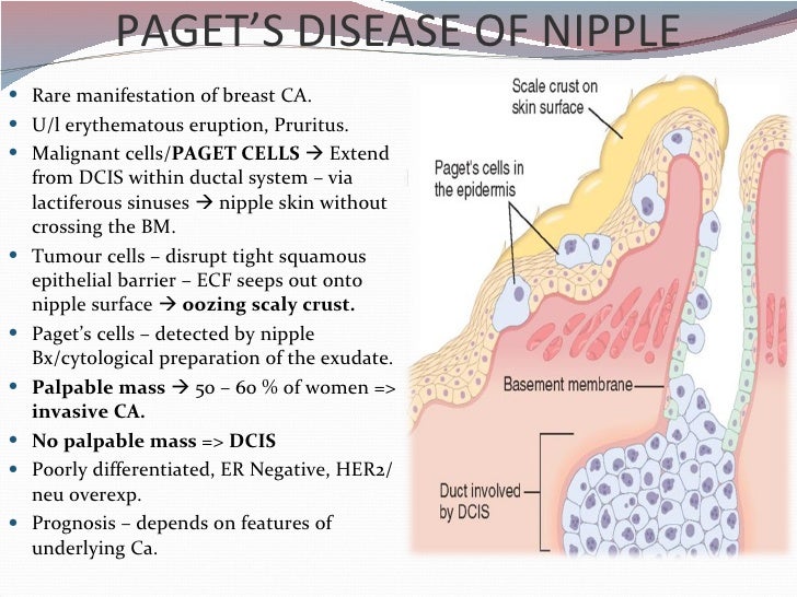pagets disease of the breast pictures 56266 pagets disease of the breast pictures 56265