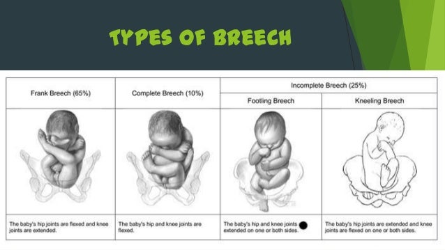 Breech Presentation breech-presentation