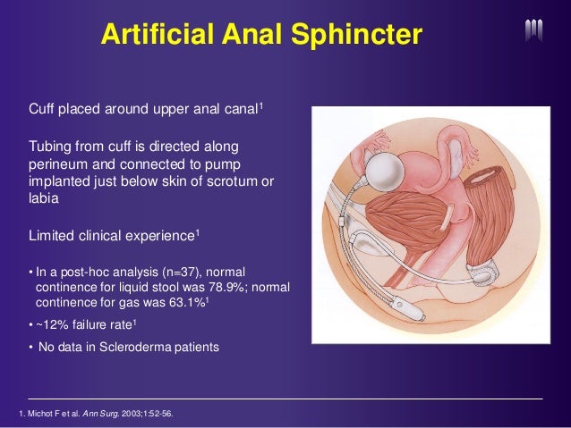 Artificial Anal Sphincter 53