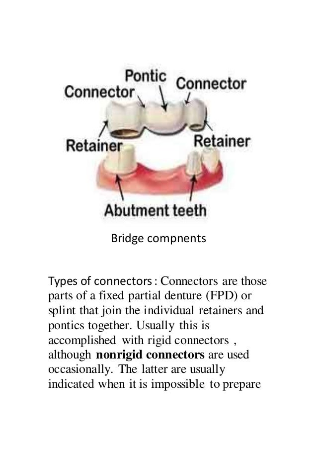 different designs of dental bridges