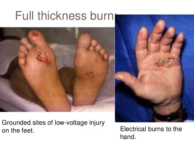 burn