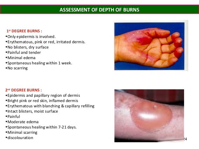 Burns: First aid - Mayo Clinic