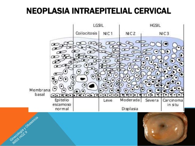 Cancer Cervicouterino Nom