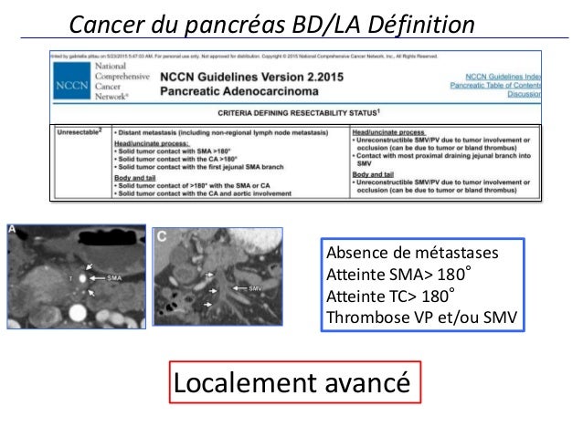 Radiothérapie alimentation cancer poumon avec metastase osseuse