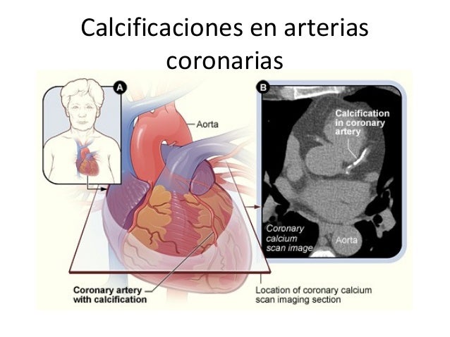 Calcificacion