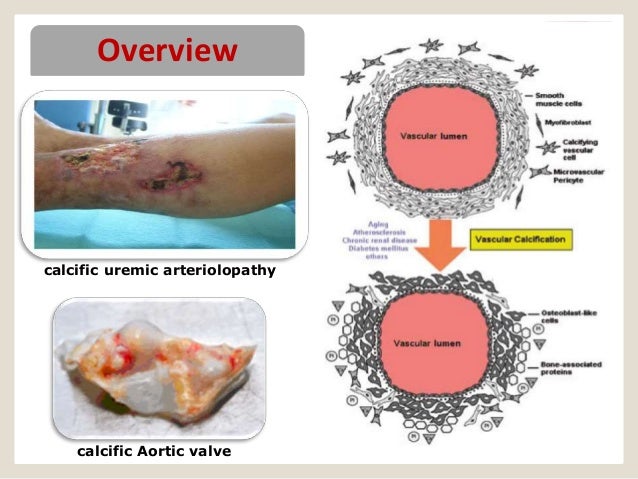 Kidney Dialysis danger factor