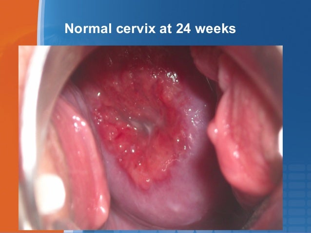 Endometrial most cancers joint pain uterine cancer lower back ache