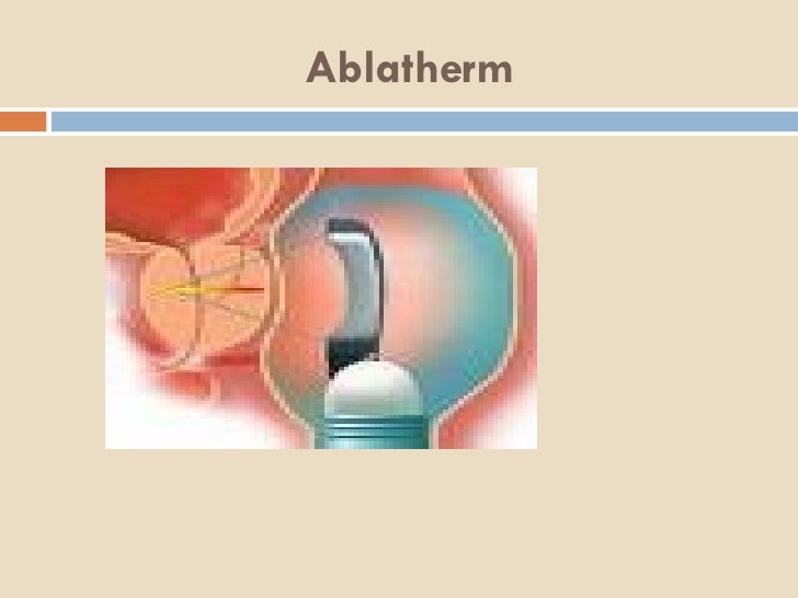 Radiotherapie Hormonotherapie Apres Prostatectomie