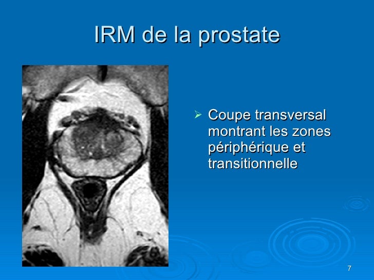 Traitement Recidive cancer Prostate Apres Prostatectomie
