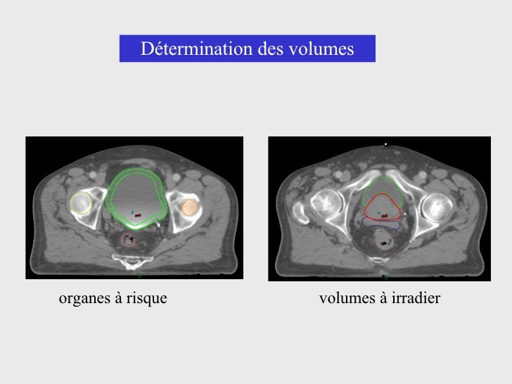 La Curiethérapie Prostatique