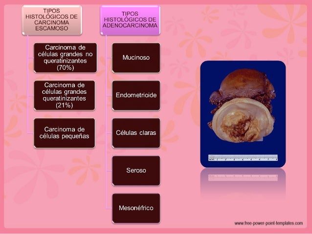Most cancers Cervix Estadificacion Figo