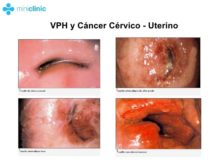 Cervical nerve treatment memories of symptoms of cervical cancer