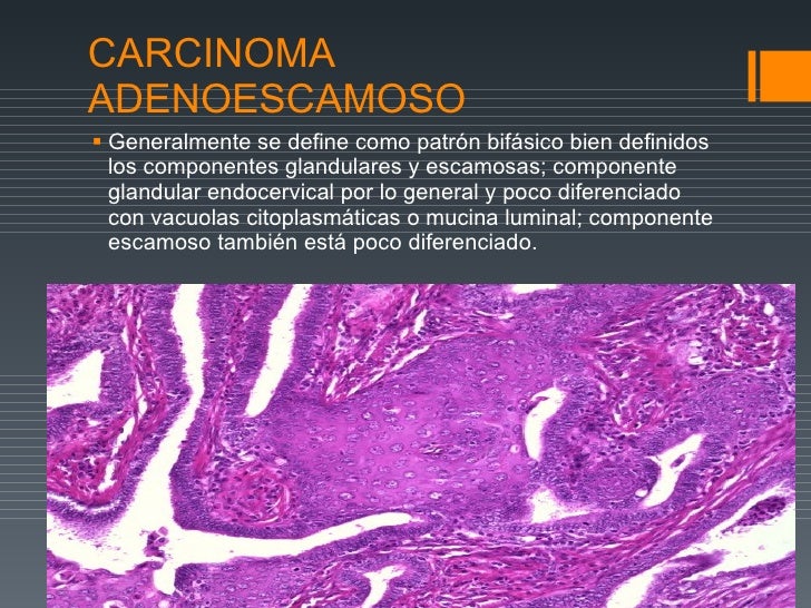 Cancer De Cervix Estadios