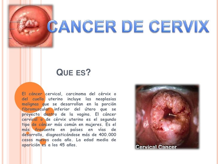 C ncer de cuello uterino - Diagn stico y tratamiento - Mayo Clinic