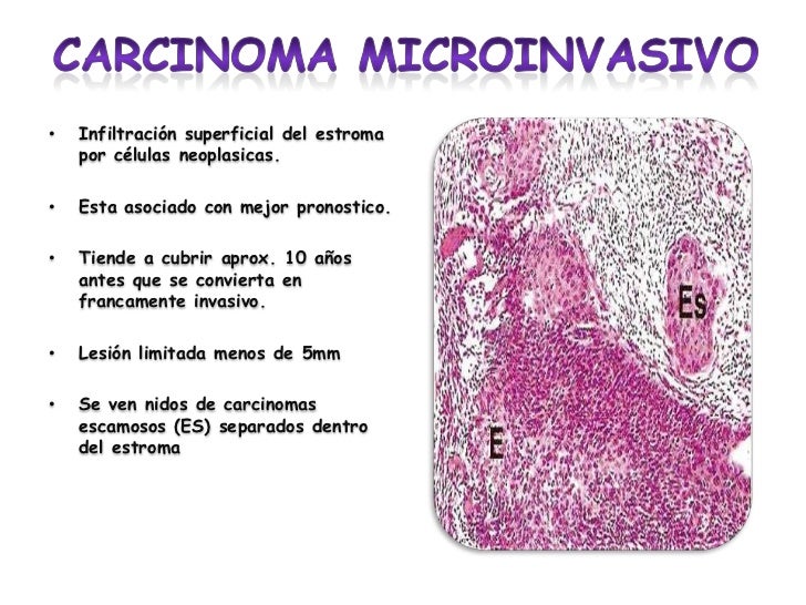 degree 2 cervical most cancers analysis