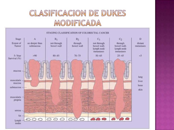 Cancer De Colon Cancer De Colon
