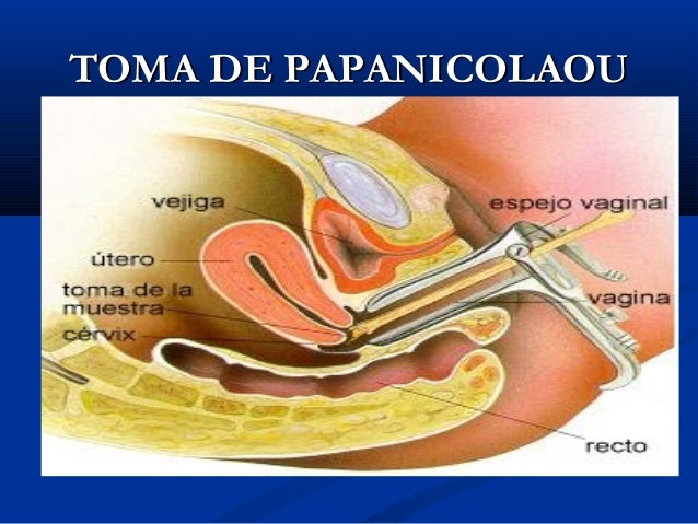 Cancer De Cervix Minsa