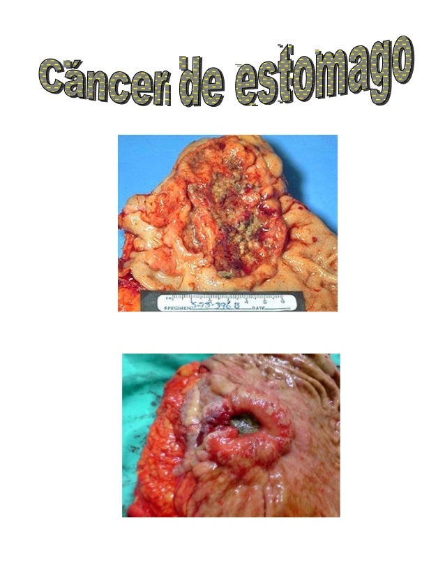 Cancer de estomago