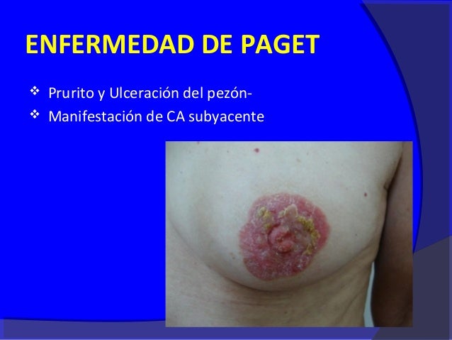 De fotos cancer seno De fotos cancer seno