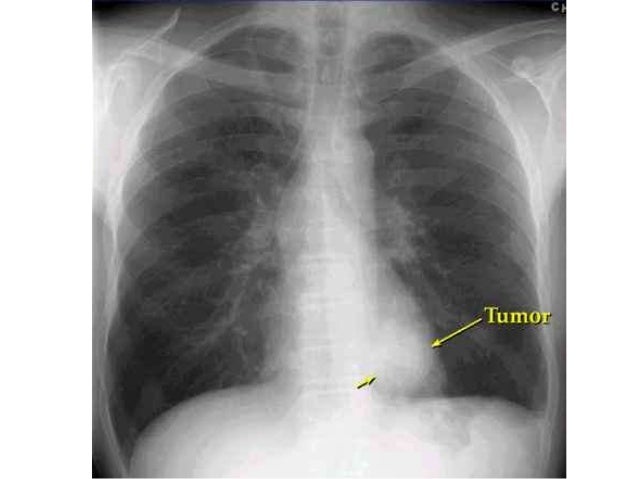Los hinchazones sheynogo del departamento de la columna vertebral los síntomas y el tratamiento