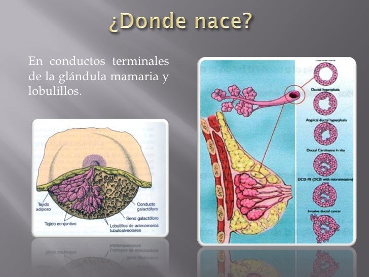 Tratamiento Del Cancer De Seno Wikipedia