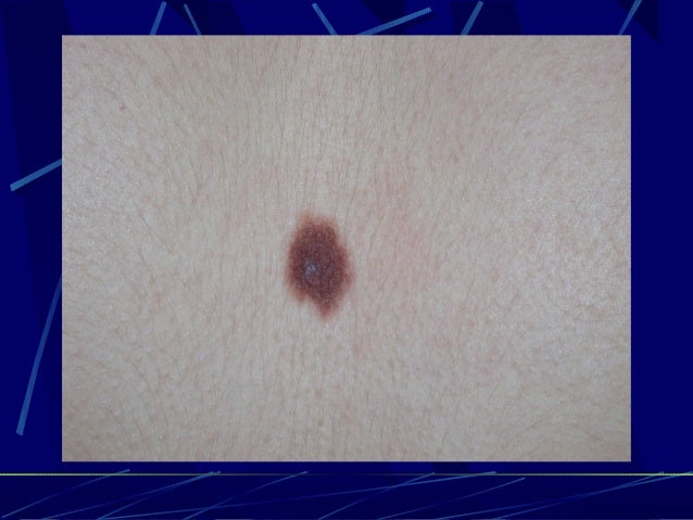 Carcinome okératoacanthome