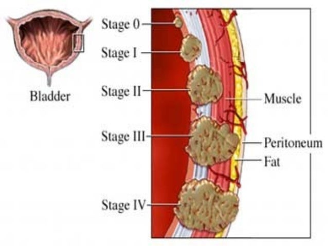Anal cancer remedy cervical vertebrae remedy