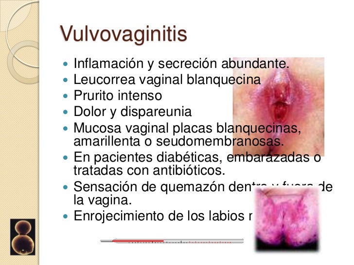 Candidiasis Dolorosa Sintomas Candida Albicans Yeast Infection Go