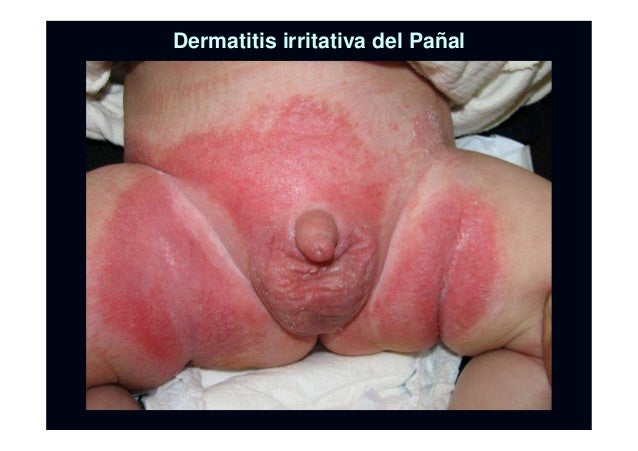 La eccema que se moja y seca el tratamiento