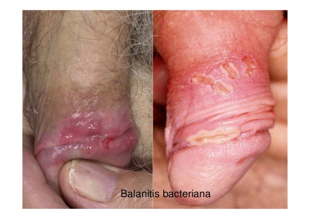 CANDIDIASIS