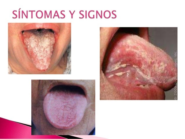 Sintomas cancer de lengua fotos