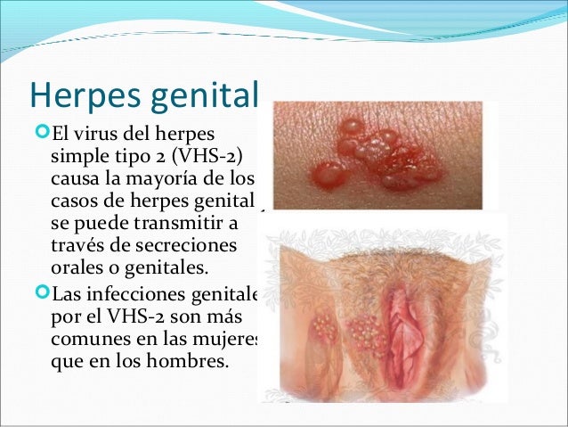 Genital Herpes Symptoms in Men - STDcheck.com