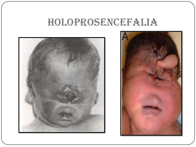 Resultado de imagen para holoprosencefalia